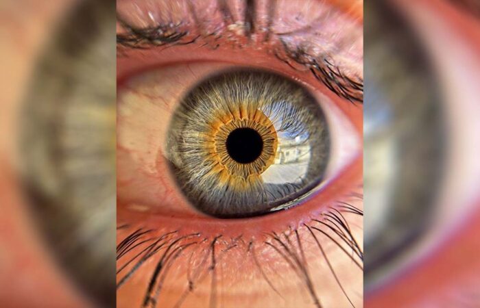 apple of the eye staining apple of the eye