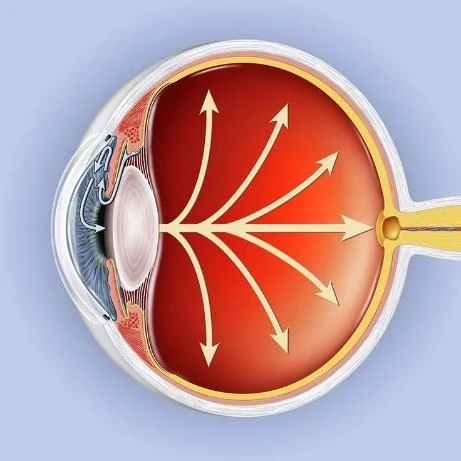 AIs Role in Addressing the Glaucoma Crisis